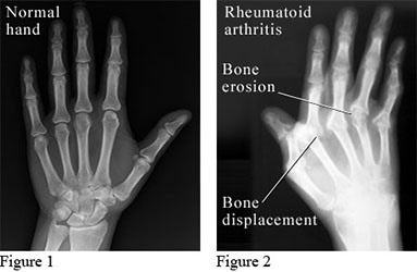 A rheumatoid arthritis differenciáldiagnózisa az arthritis jellege és a kísérő tünetek alapján